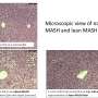 High-salt diet may drive fatty liver disease differently in lean people