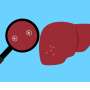 Aspirin did not prevent recurrence after liver metastasis surgery, study shows