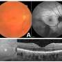 Eye infections can steal sight, but early diagnosis can save vision