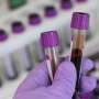 Blood RNA markers may flag lung cancer risk 10 years before diagnosis